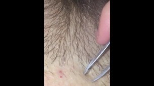 Ingrown Hairs Bikini Line