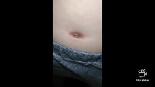 [belly button / navel] deep innie base to outie with syringe 2