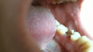 Rotten Tooth and Fillings