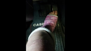 Peddle pumping with a broken ankle and cast