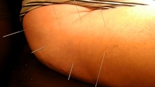 Bad acupuncture