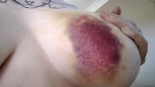 Extreme Bruising After Car Accident (2016)
